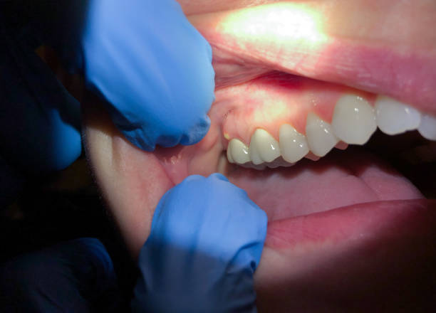 Best Emergency Treatment for Oral Infections in Westfield, PA