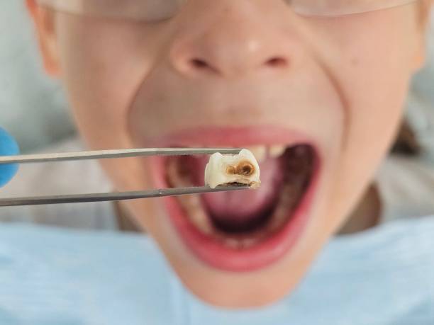 Best Knocked-Out Tooth (Avulsed Tooth) Treatment in Westfield, PA